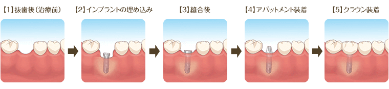 【1】抜歯 【2】インプラントの埋め込み 【3】縫合 【4】アバットメント装着 【5】クラウン装着